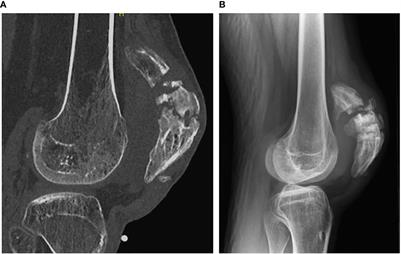 Rt patella clearance